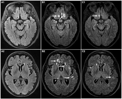 Case report: A case of anti-glycine receptor encephalomyelitis triggered by post-transplant or COVID-19 infection?